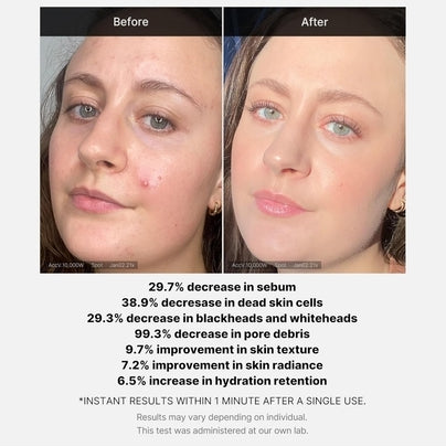 [MEDICUBE] Red Acne Succinic Acid Peel 40g